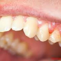 Điều trị Nha chu - Nạo láng gốc răng
